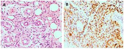 Chronic Active Epstein-Barr Virus Infection With Systemic Vasculitis and Pulmonary Arterial Hypertension in a Child